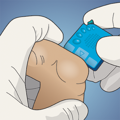 Babylance Newborn hielprik geel, doos 50 stuks - Afbeelding 6